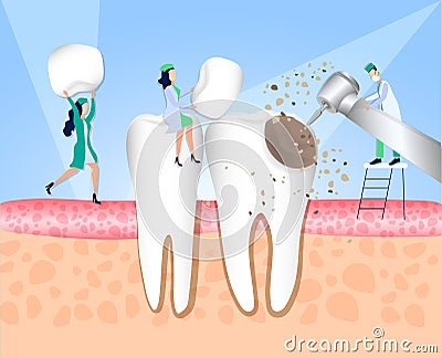 Dentistry. Doctors treat teeth affected by caries. Enamel damage, tooth infection, bacteria. Dentistry, treatment of toothache. Ve Vector Illustration